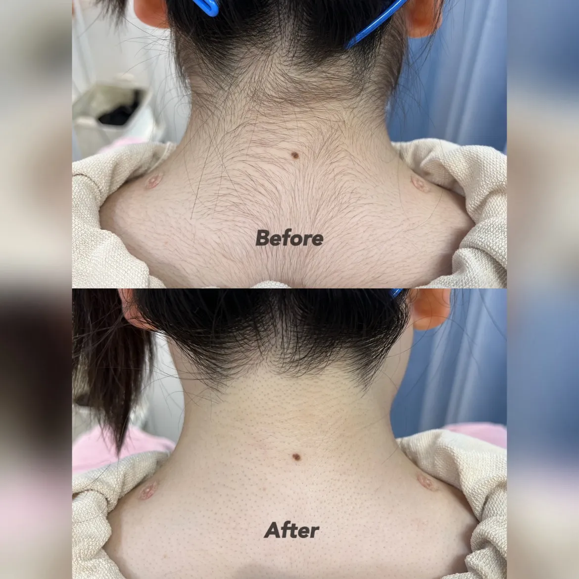 上半身ケアクーポン (顔+背中半分+肩から肘+拭き取りパック)