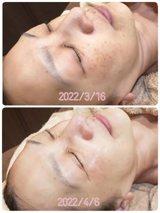 お顔そり+フォトフェイシャル