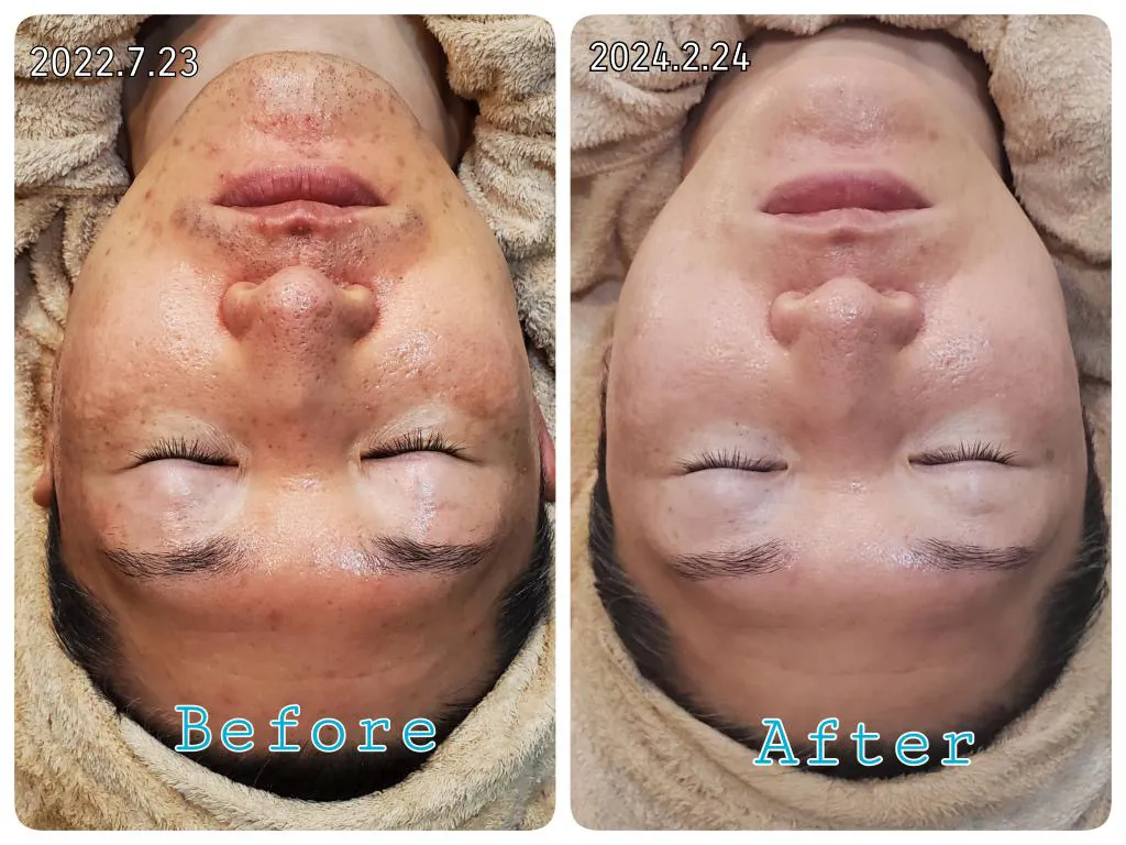 臍帯血幹細胞導入