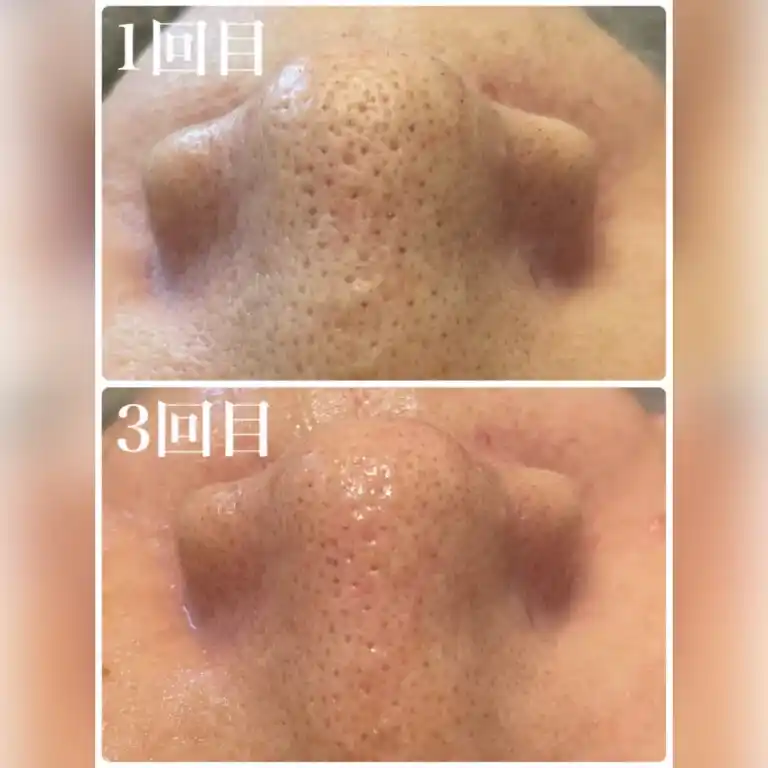 毛穴洗浄シェービング　初回価格