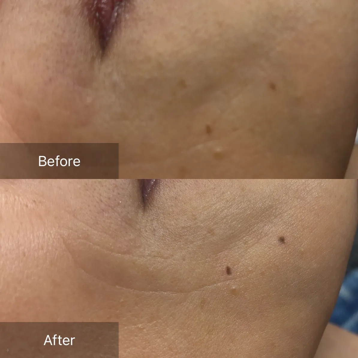 花みずきシミケア