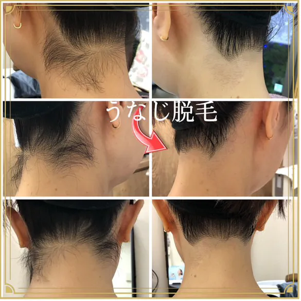 レディースフェイシャル脱毛、美肌パーフェクトコース